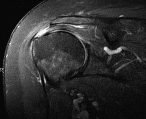 Rupture Des Tendons De La Coiffe Des Rotateurs L Paule Centre Main Epaule Mediterran E